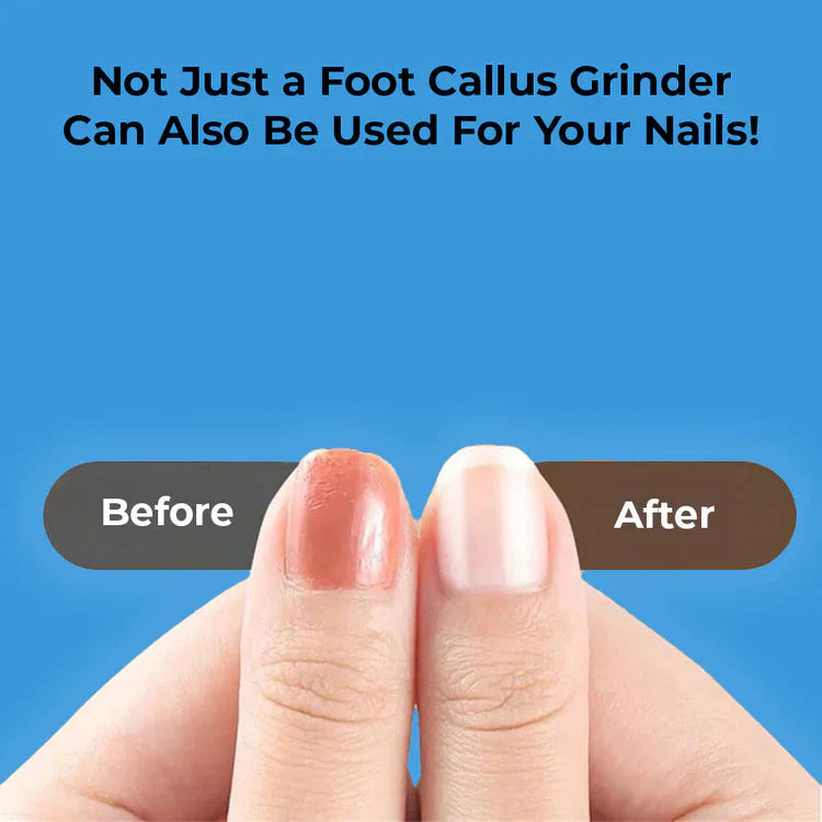 Electric Foot Callus Remover – Rechargeable Pedicure Tool for Smooth & Soft Feet